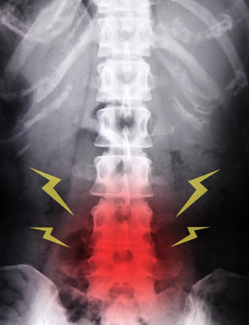 椎間板ヘルニアによる炎症のイメージ
